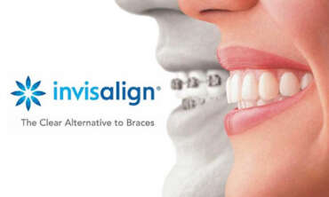 Invisalign